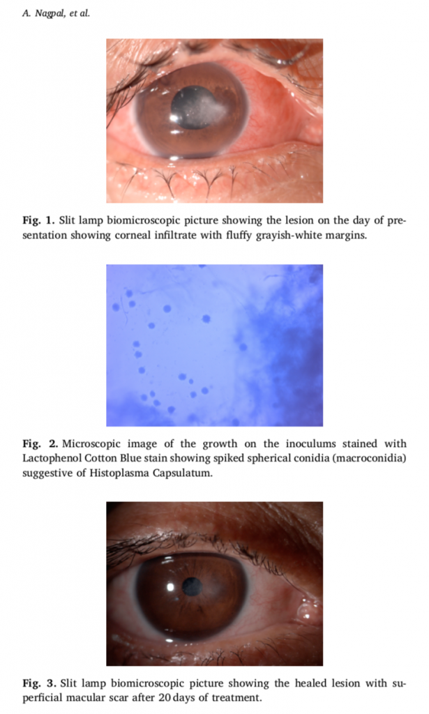 HISTOPLASMA CORNEAL INFECTION